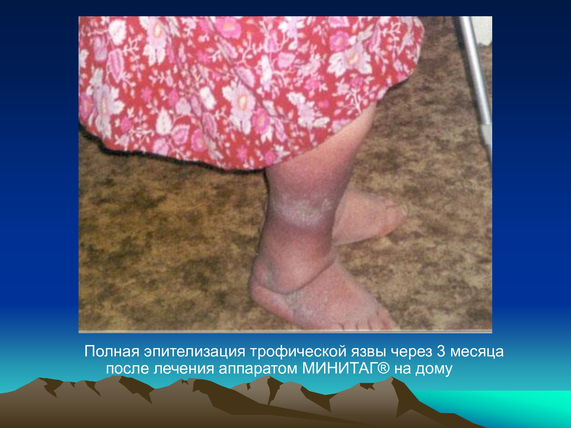 Специализированное медицинское устройство, предназначенное для воздействия на очаг патологии, БАТ электромагнитного излучения, генерируемое прибором.