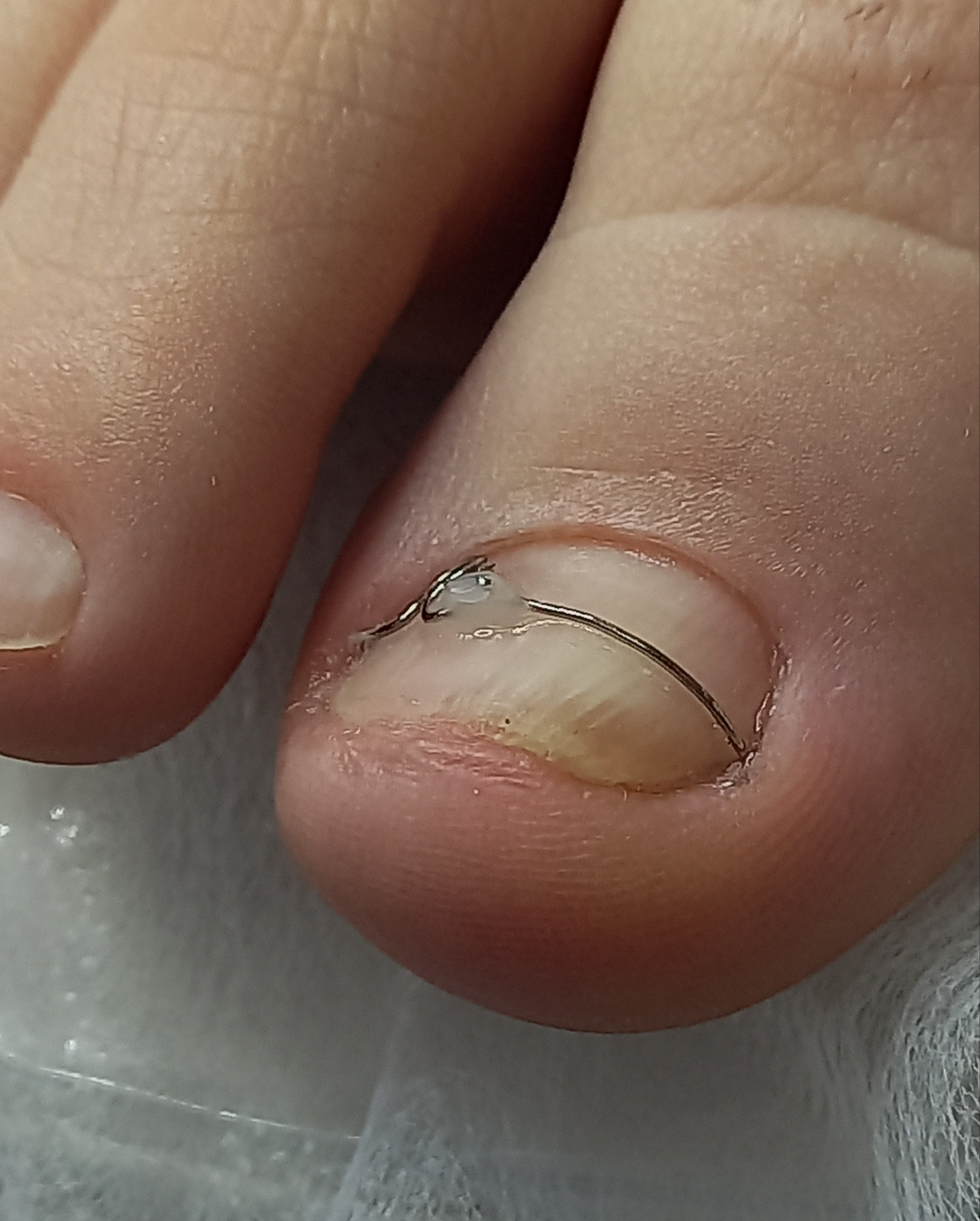 Коррекционная система ORA. Подолог г. Хабаровск — центр здоровой стопы «FOOTTIME»