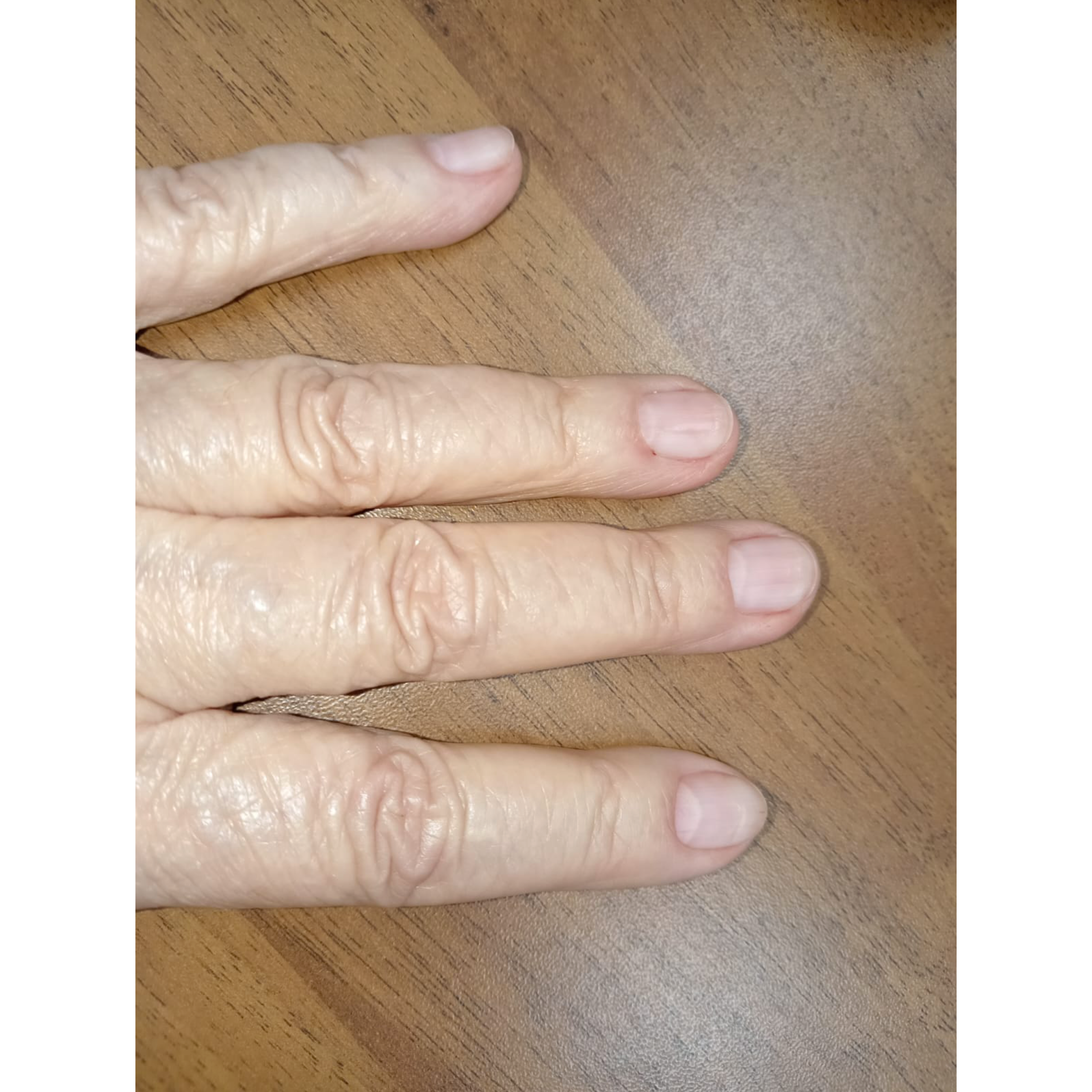 Ожог после гельлака. Подолог г. Хабаровск — центр здоровой стопы «FOOTTIME»