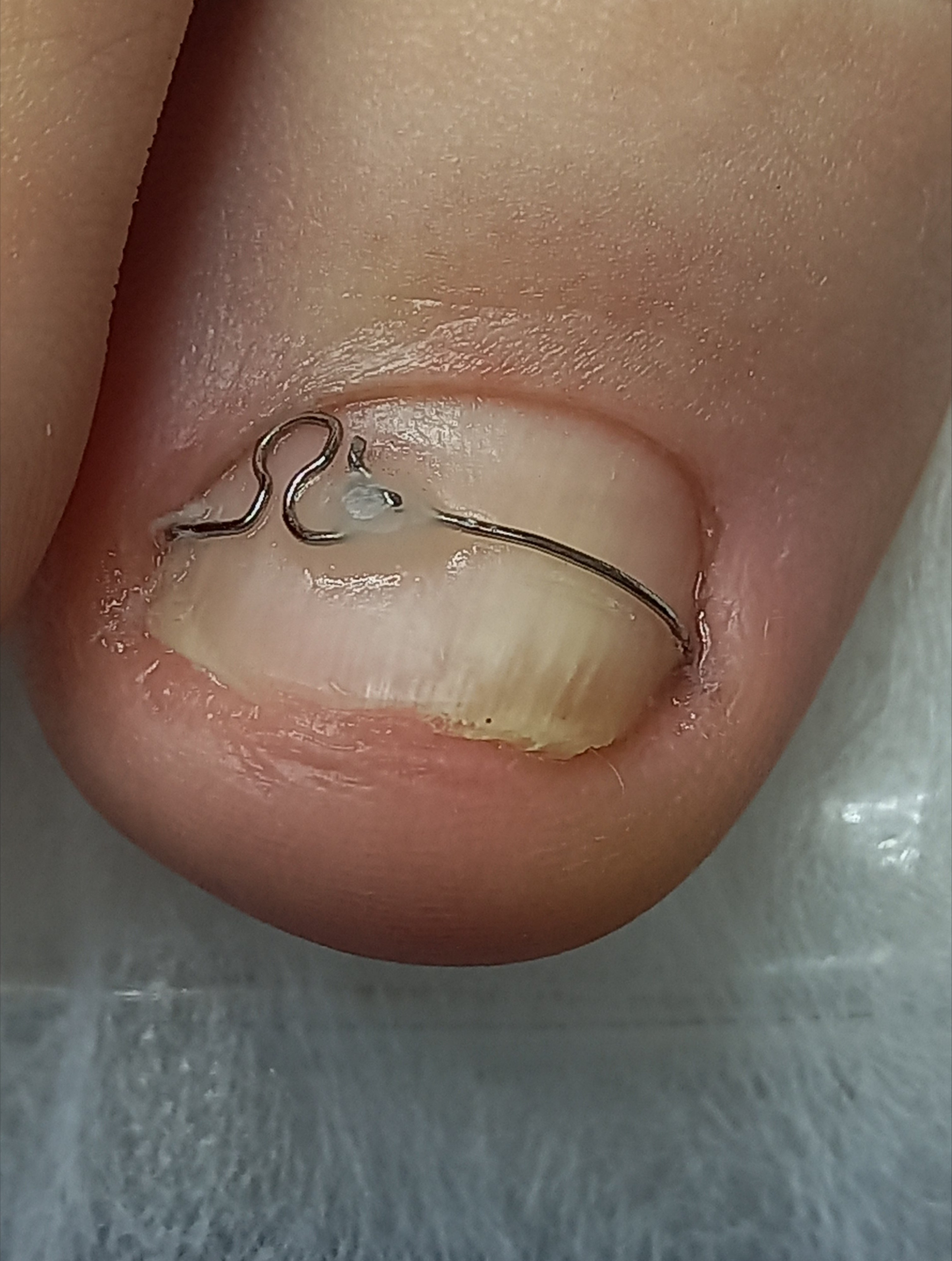 Коррекционная система ORA. Подолог г. Хабаровск — центр здоровой стопы «FOOTTIME»