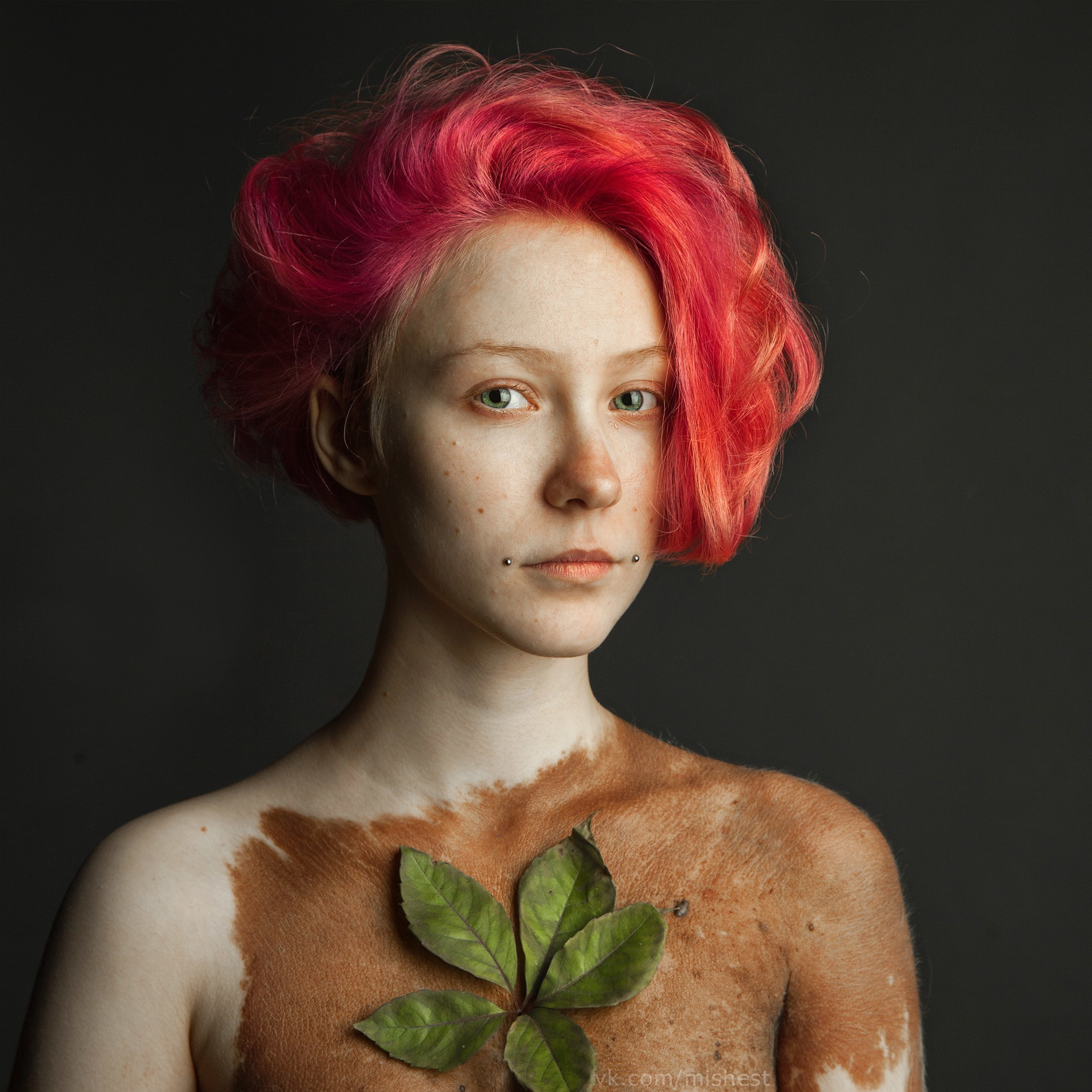 У меня врожденный гигантский невус. Михаил Шестаков