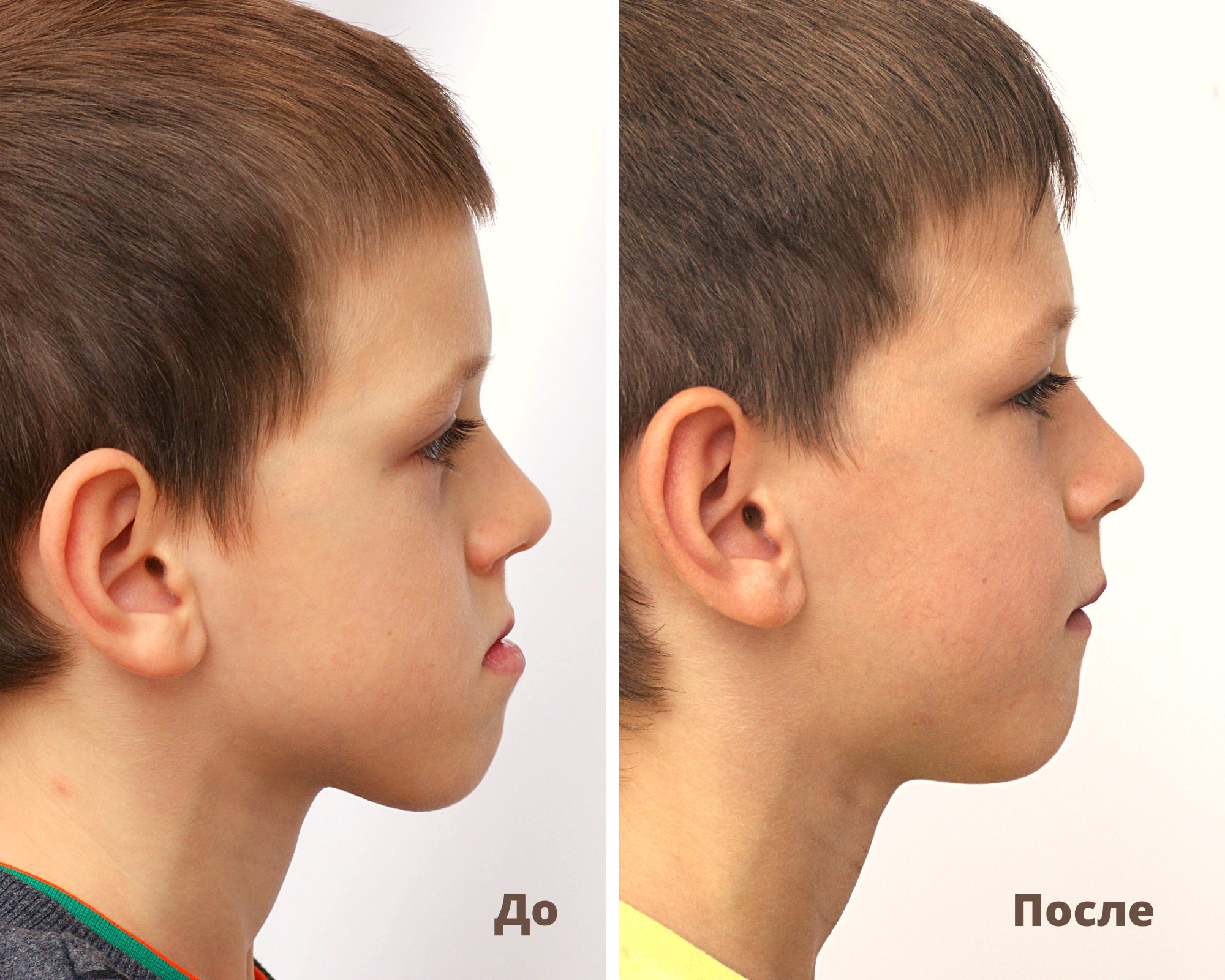 Блог врача. Стоматология «Ортодонт-Эстетик». Установка брекетов в Оренбурге, взрос