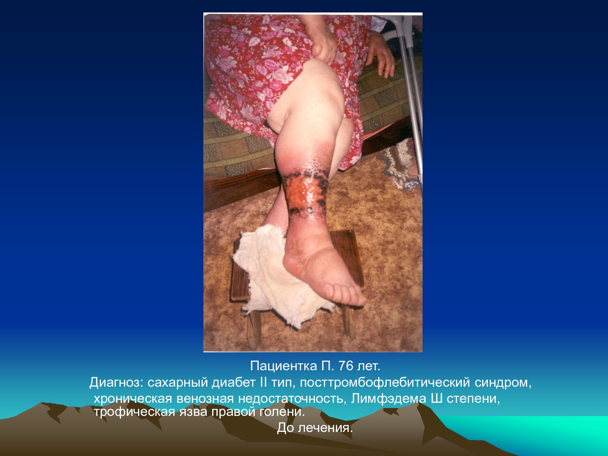 Специализированное медицинское устройство, предназначенное для воздействия на очаг патологии, БАТ электромагнитного излучения, генерируемое прибором.