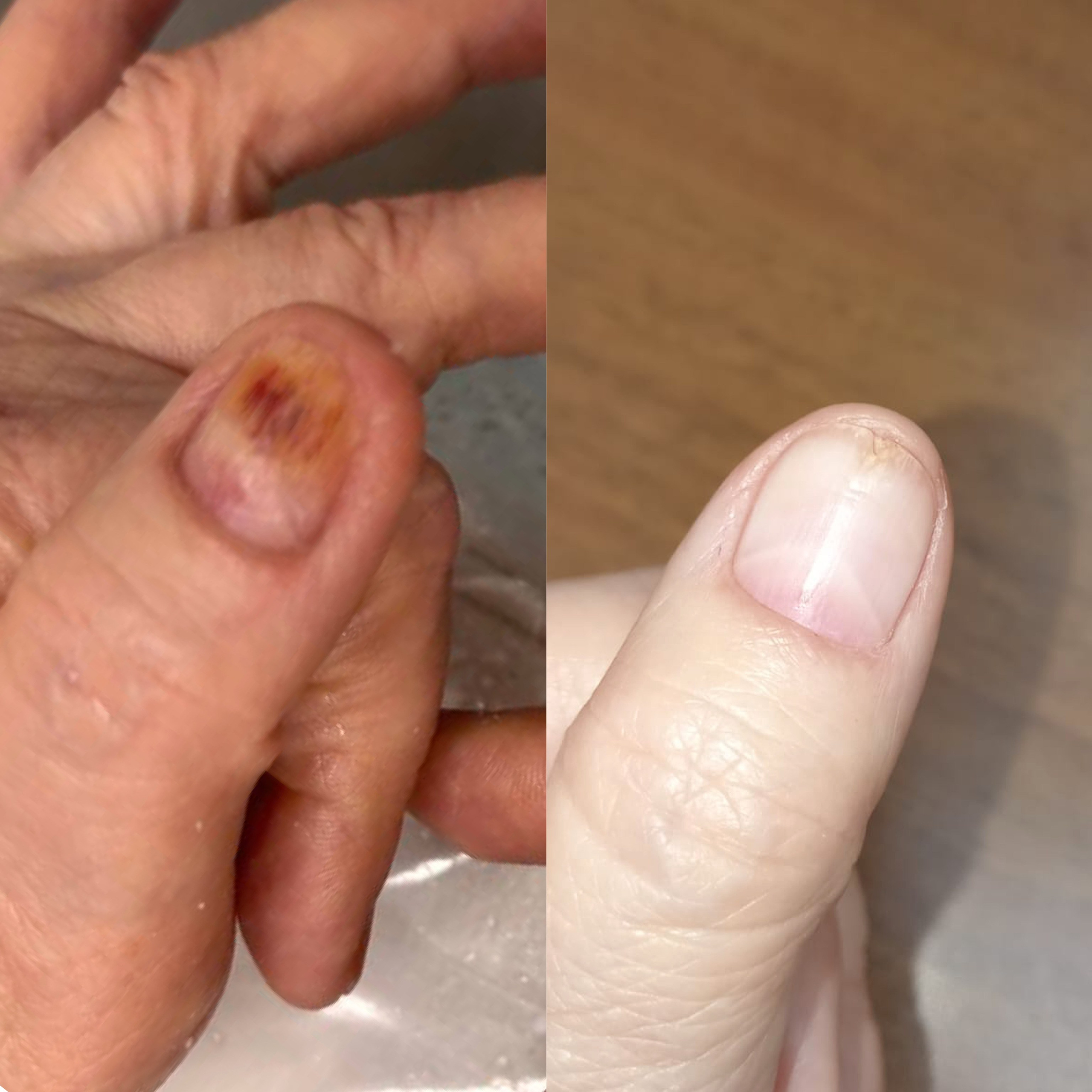 Ожог после гельлака. Подолог г. Хабаровск — центр здоровой стопы «FOOTTIME»
