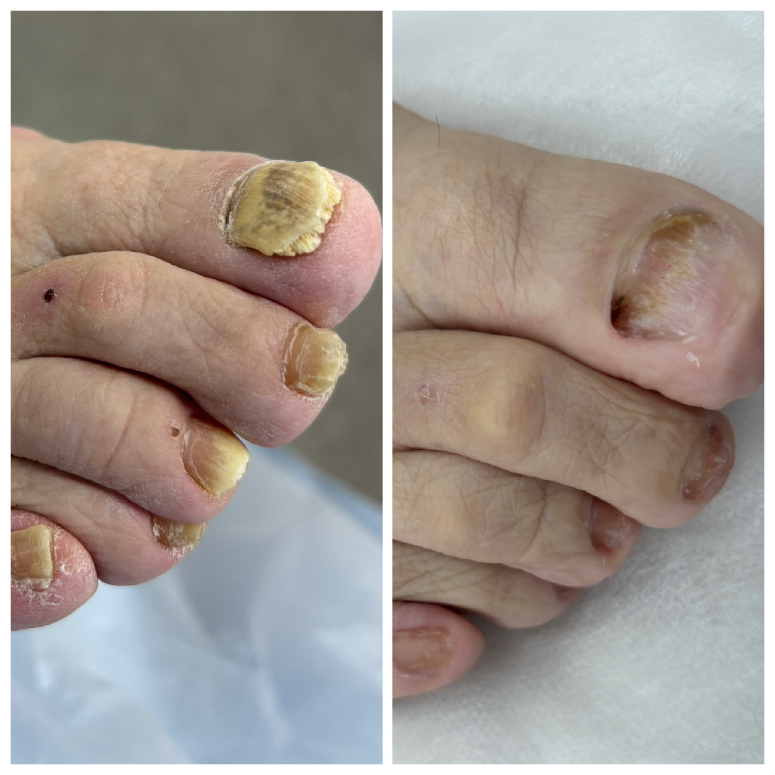 Подготовка грибковых ногтей к лечению. Подолог г. Хабаровск — центр здоровой стопы «FOOTTIME»