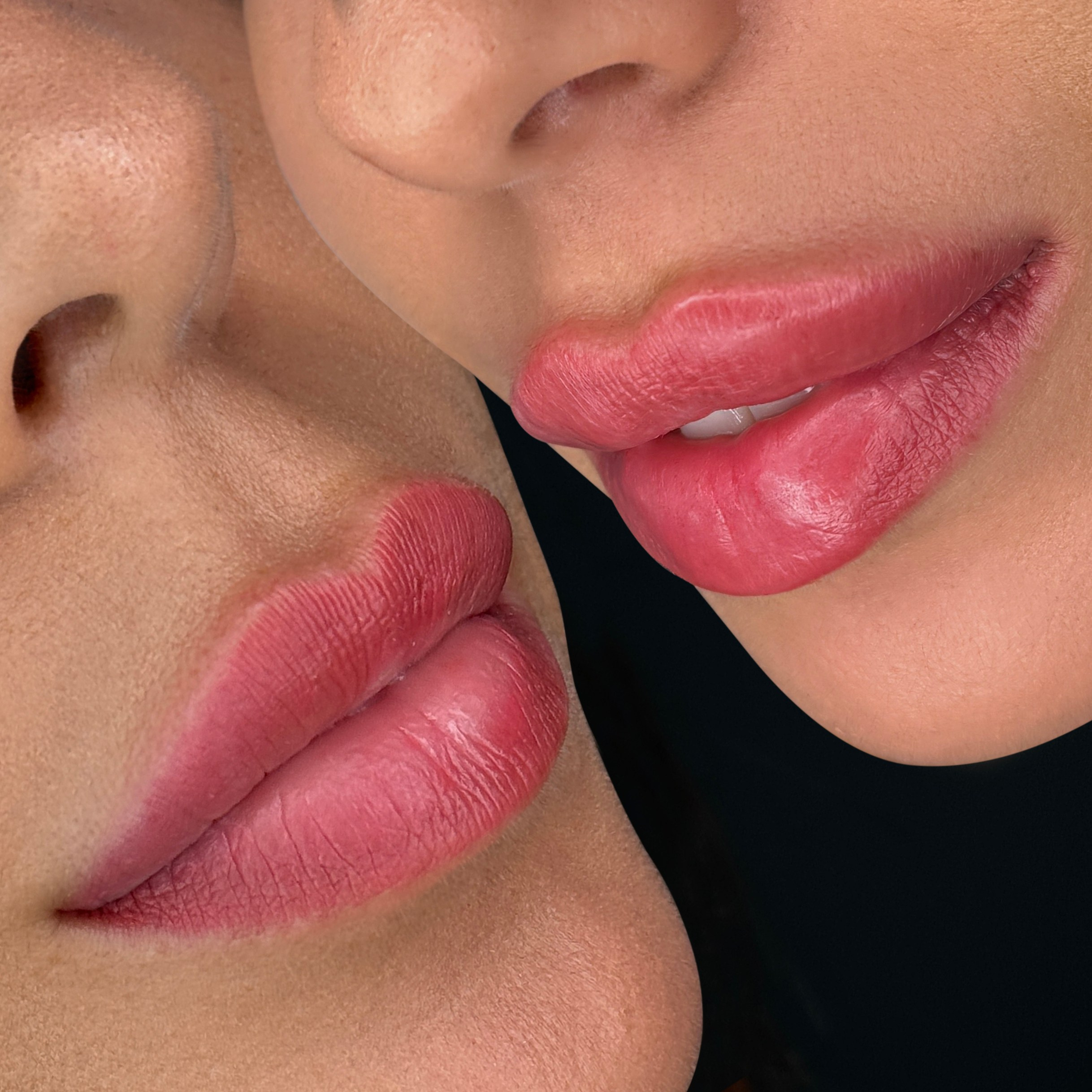 Увеличение губ филлерами в Москве — цена от 18 000 ₽, фото до и после | Студия SYMMETRY