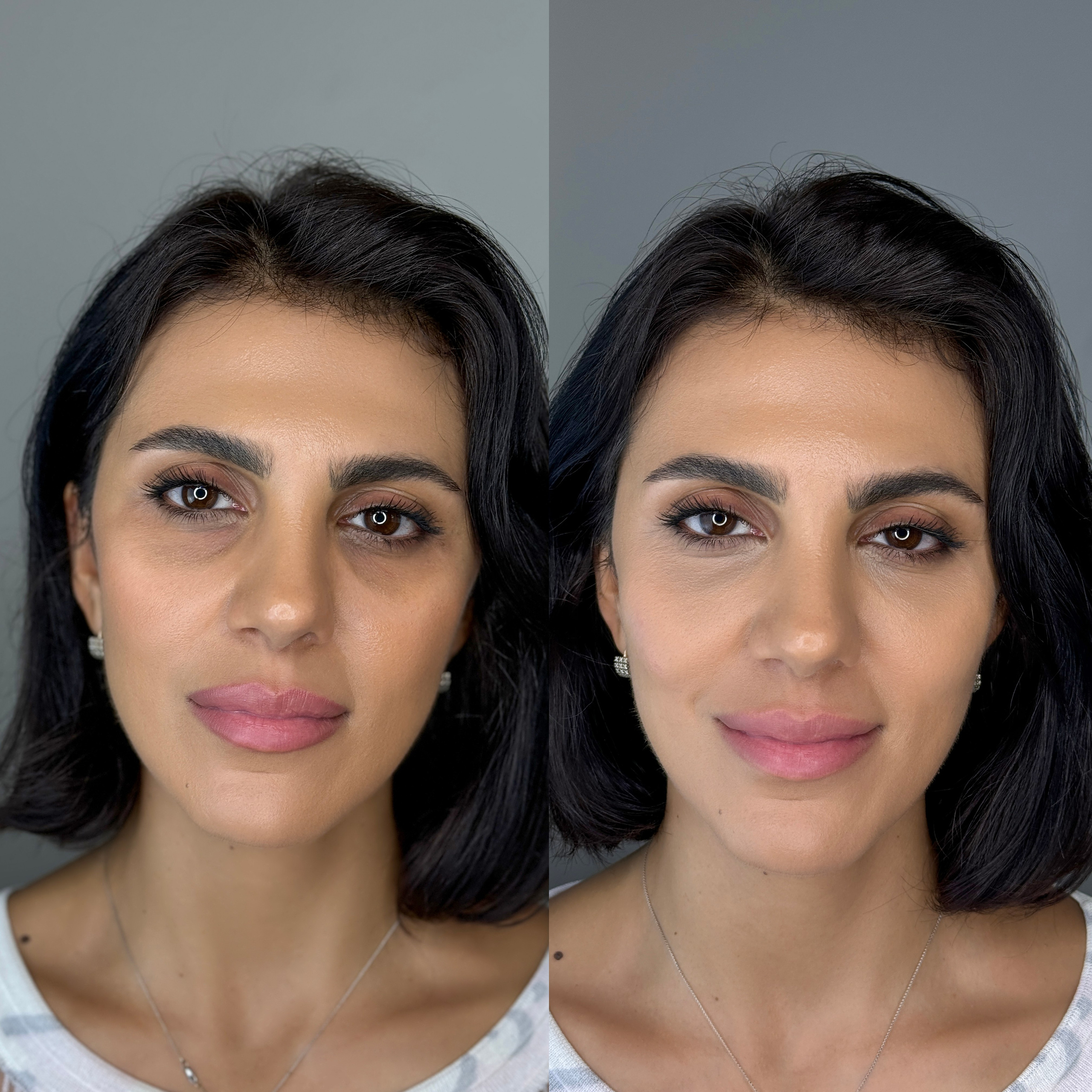 Увеличение губ филлерами в Москве — цена от 18 000 ₽, фото до и после | Студия SYMMETRY