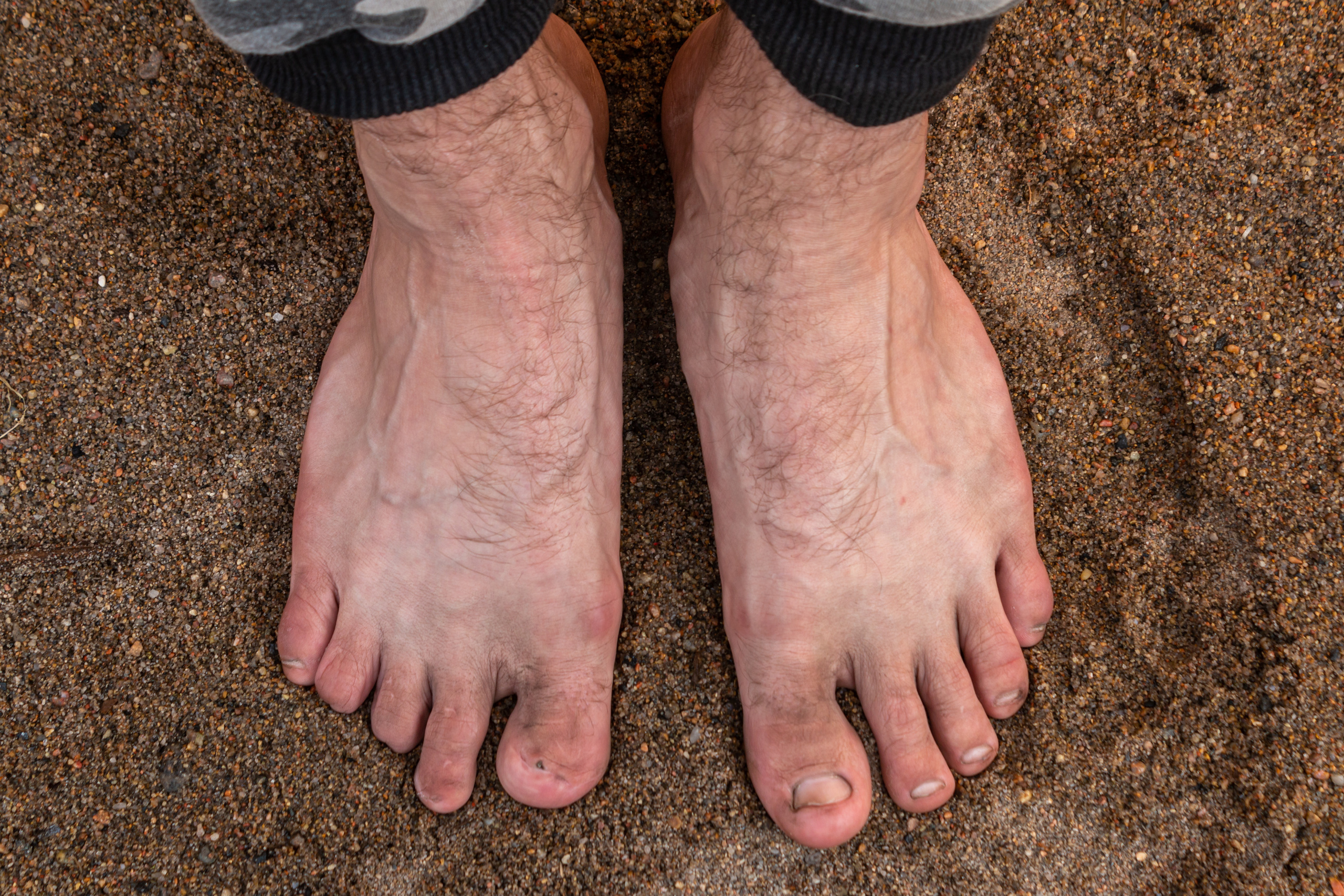 Zhenya's (not the real name) toe tips on the right foot were smashed by the wheels of a high speed train «Sapsan». During an unsuccessful attempt to hop the train, he fell on the tracks and wasn't fast enough to crawl away.