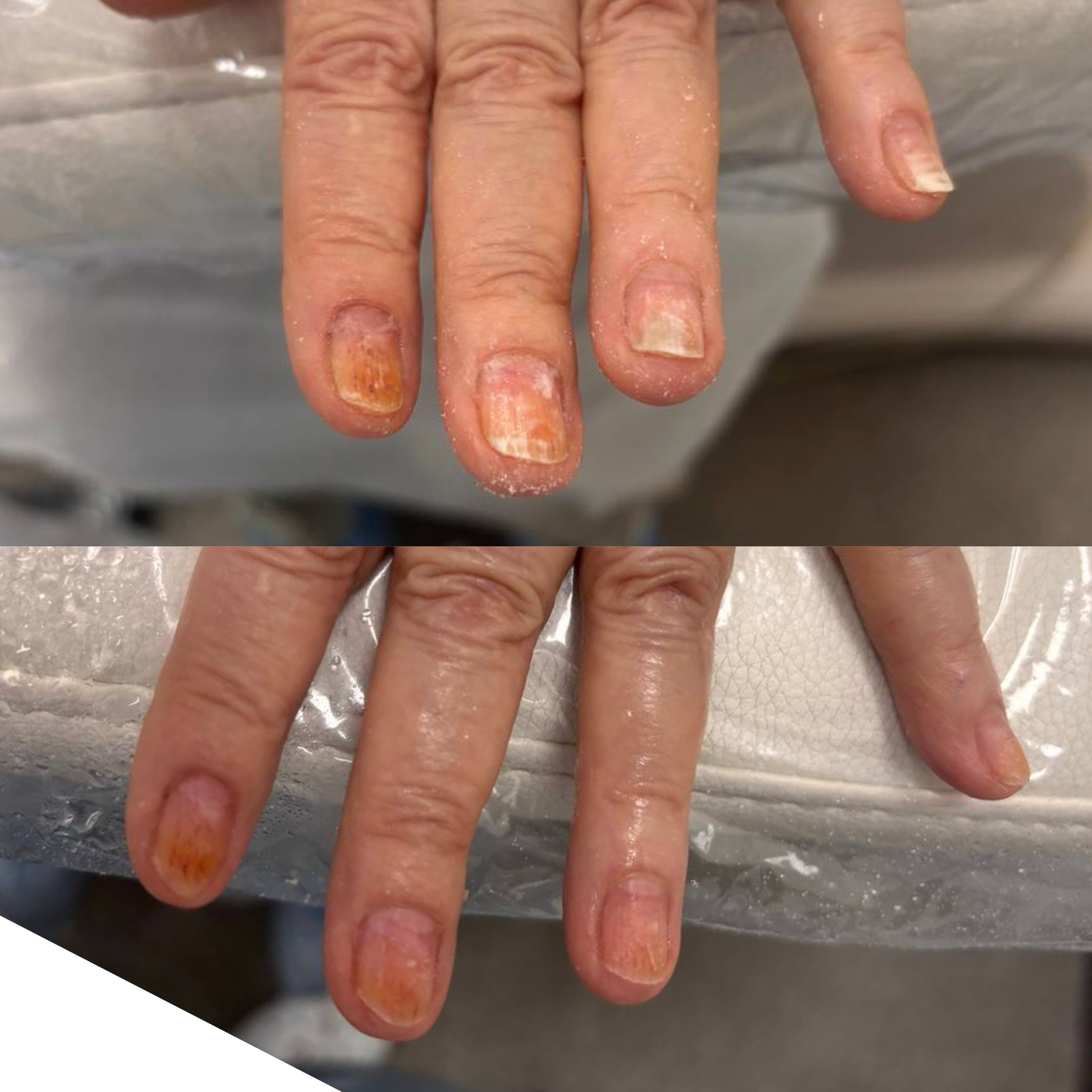Ожог после гельлака. Подолог г. Хабаровск — центр здоровой стопы «FOOTTIME»