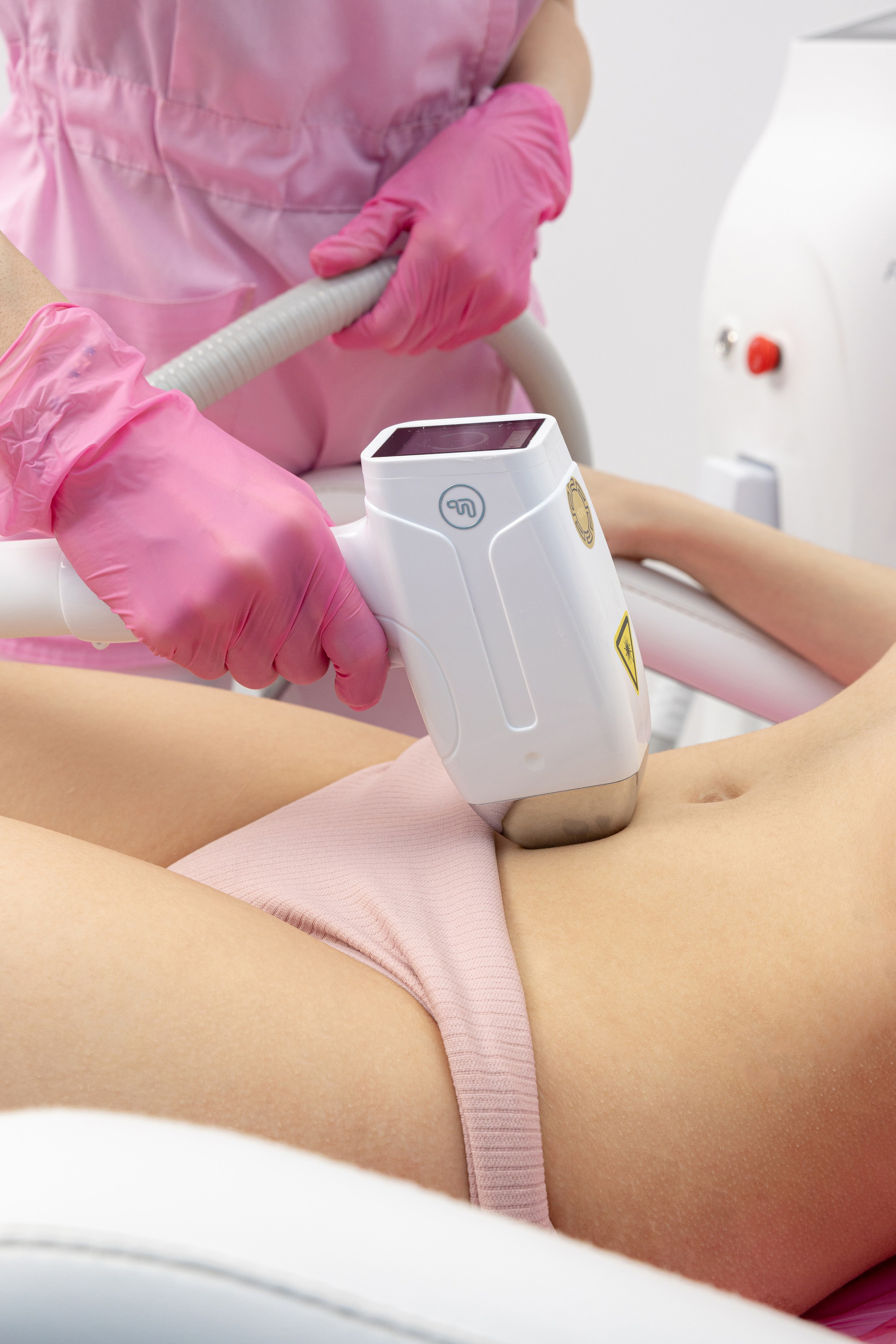 Лазерная эпиляция в зоне живота