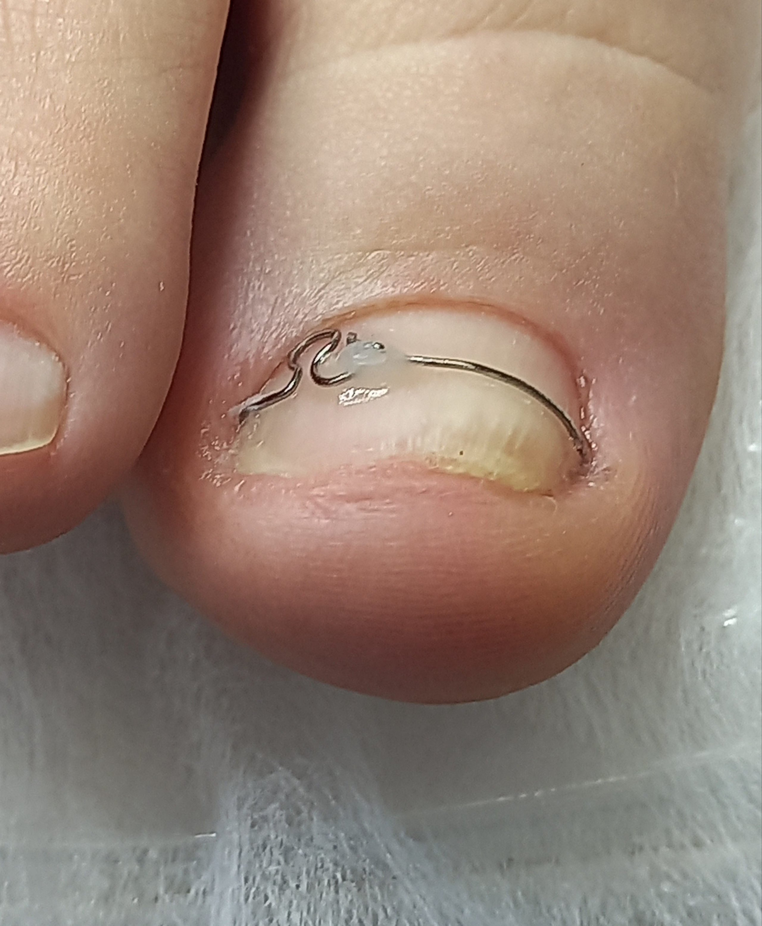 Коррекционная система ORA. Подолог г. Хабаровск — центр здоровой стопы «FOOTTIME»