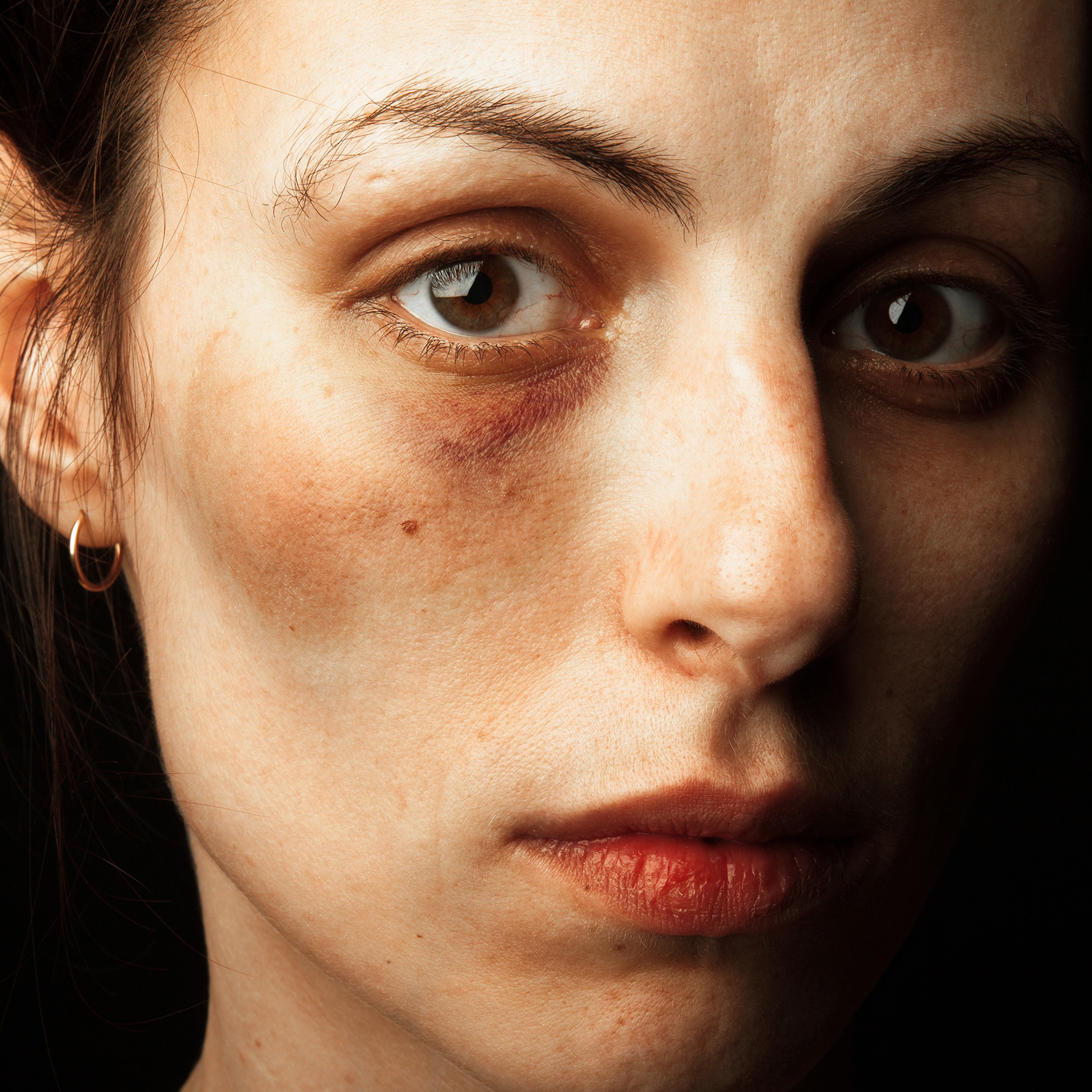 Произошла череда событий, повлекших возникновение гематомы