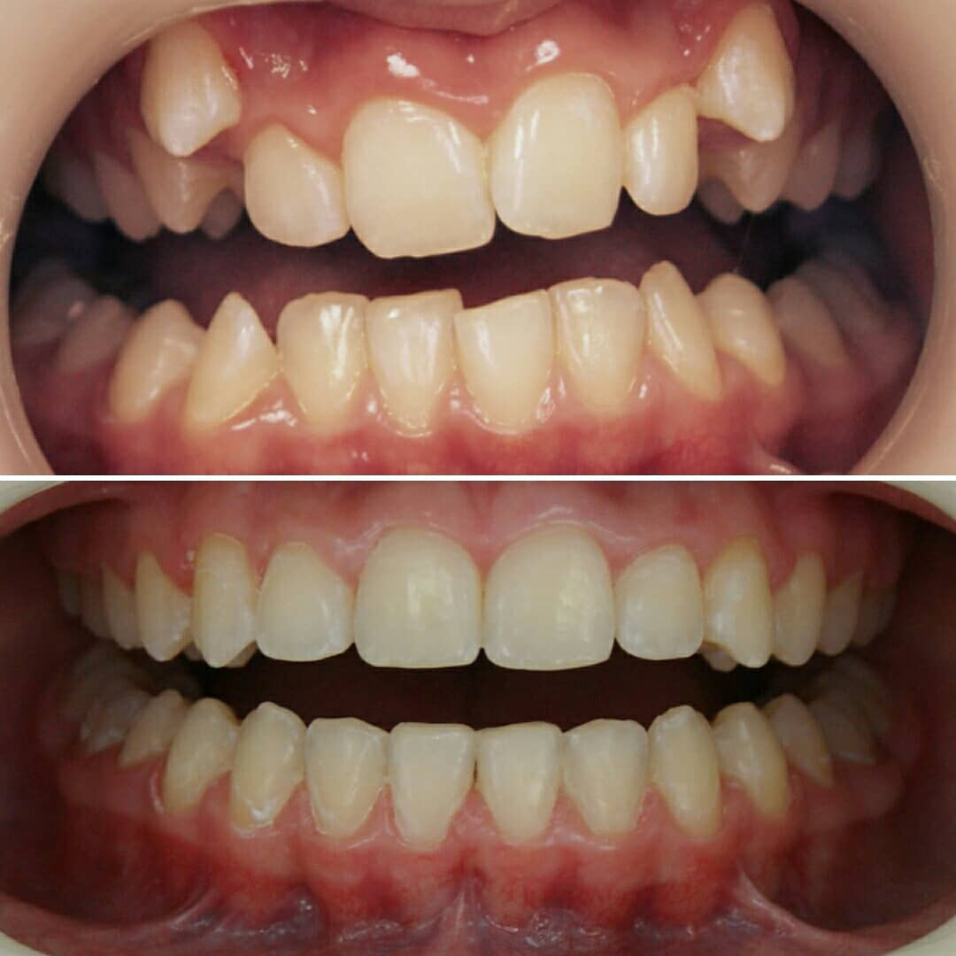 Блог врача. Стоматология «Ортодонт-Эстетик». Установка брекетов в Оренбурге, взрос