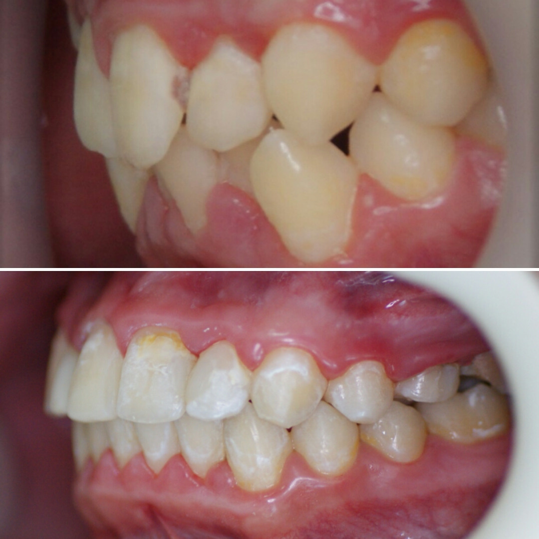 Блог врача. Стоматология «Ортодонт-Эстетик». Установка брекетов в Оренбурге, взрос