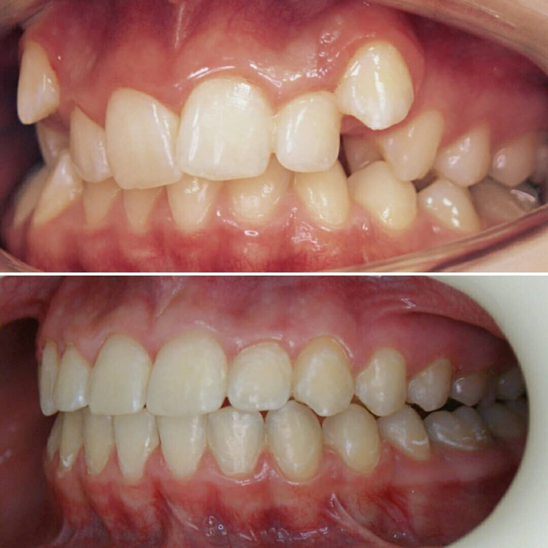 Блог врача. Стоматология «Ортодонт-Эстетик». Установка брекетов в Оренбурге, взрос