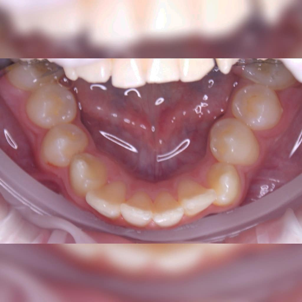 Блог врача. Стоматология «Ортодонт-Эстетик». Установка брекетов в Оренбурге, взрос
