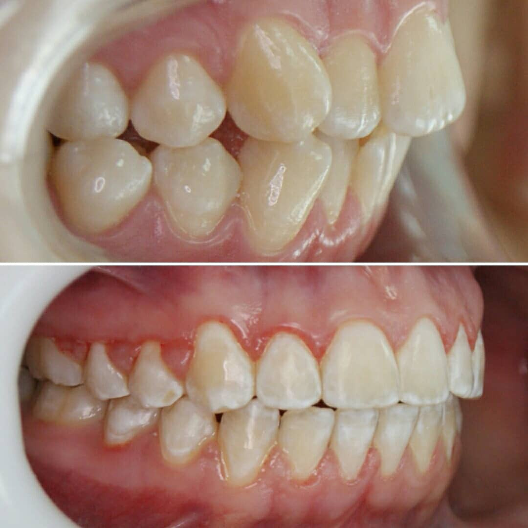 Блог врача. Стоматология «Ортодонт-Эстетик». Установка брекетов в Оренбурге, взрос