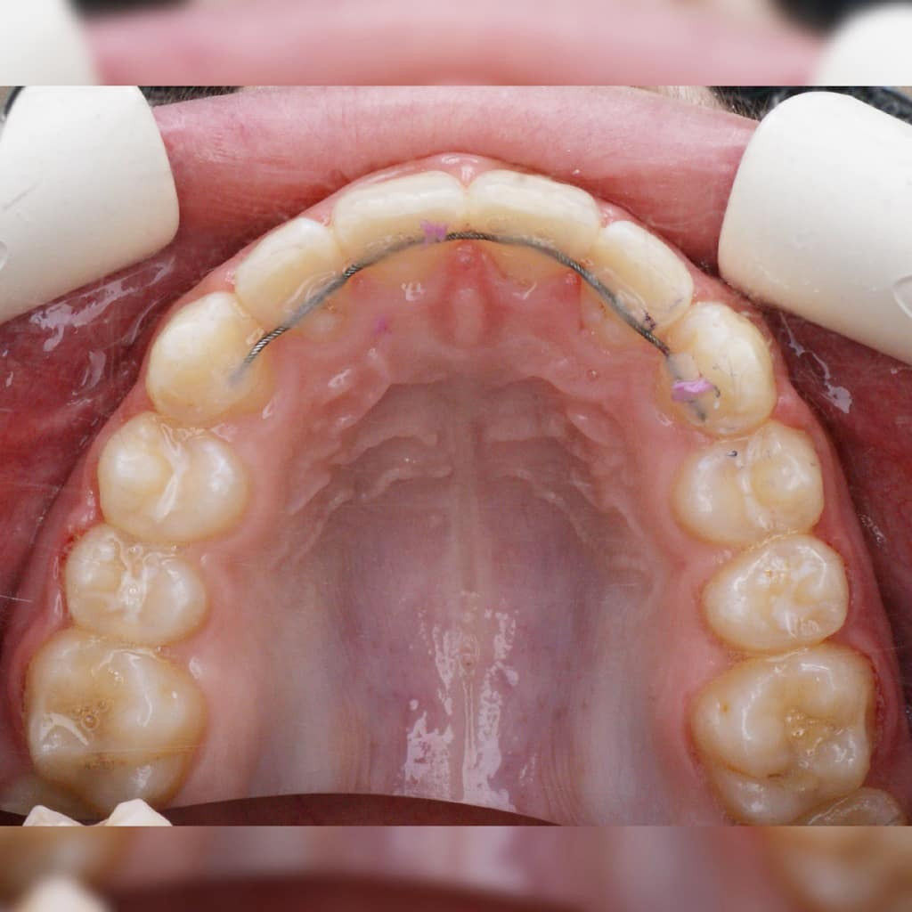 Блог врача. Стоматология «Ортодонт-Эстетик». Установка брекетов в Оренбурге, взрос