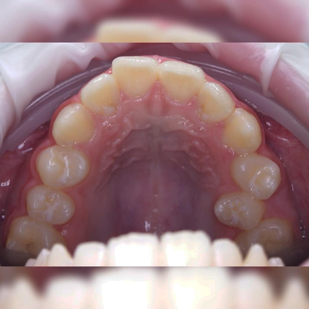 Блог врача. Стоматология «Ортодонт-Эстетик». Установка брекетов в Оренбурге, взрос