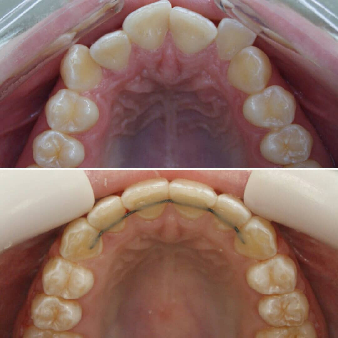Блог врача. Стоматология «Ортодонт-Эстетик». Установка брекетов в Оренбурге, взрос