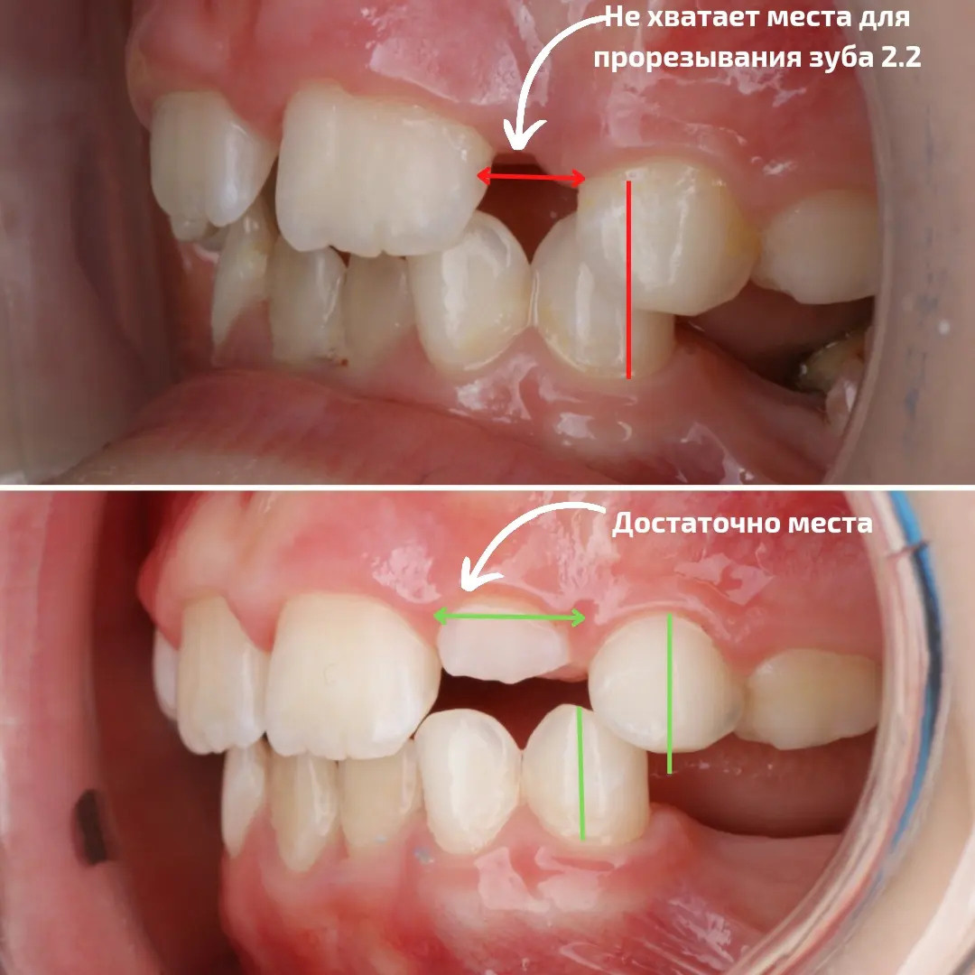 Блог врача. Стоматология «Ортодонт-Эстетик». Установка брекетов в Оренбурге, взрос