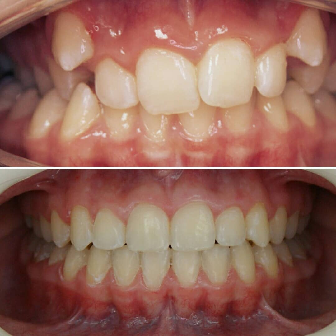Блог врача. Стоматология «Ортодонт-Эстетик». Установка брекетов в Оренбурге, взрос