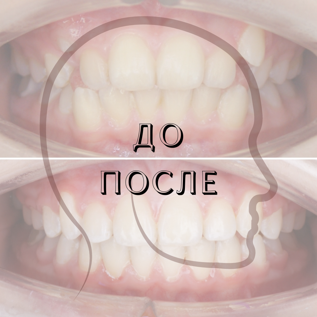 Блог врача. Стоматология «Ортодонт-Эстетик». Установка брекетов в Оренбурге, взрос