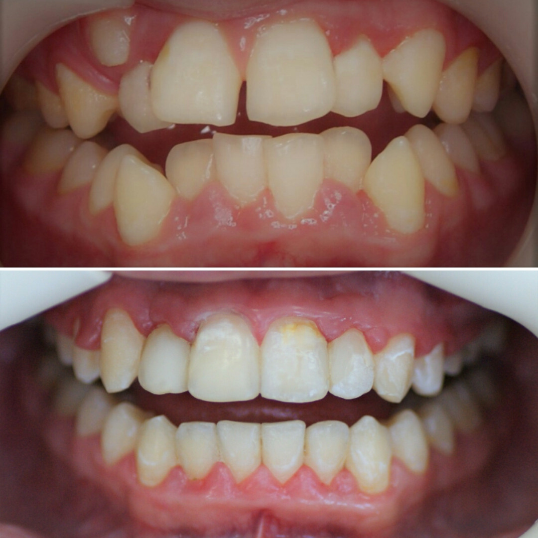 Блог врача. Стоматология «Ортодонт-Эстетик». Установка брекетов в Оренбурге, взрос