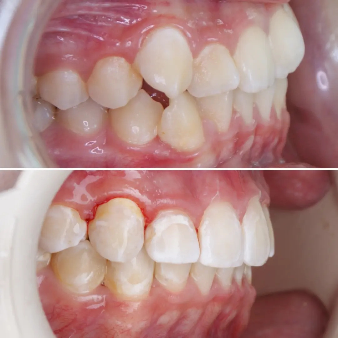 Блог врача. Стоматология «Ортодонт-Эстетик». Установка брекетов в Оренбурге, взрос
