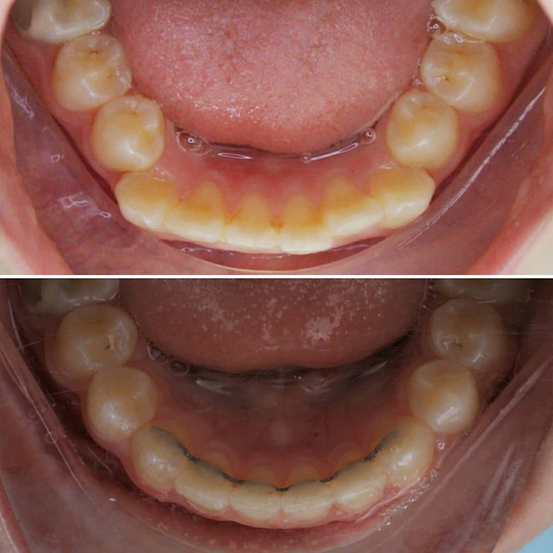 Блог врача. Стоматология «Ортодонт-Эстетик». Установка брекетов в Оренбурге, взрос