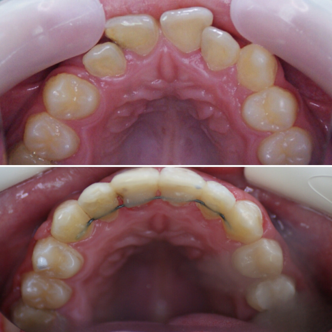 Блог врача. Стоматология «Ортодонт-Эстетик». Установка брекетов в Оренбурге, взрос