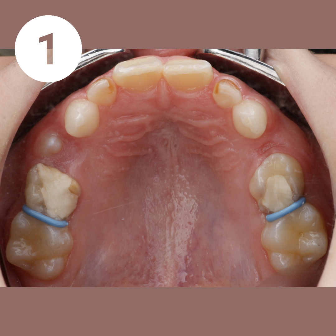 Блог врача. Стоматология «Ортодонт-Эстетик». Установка брекетов в Оренбурге, взрос