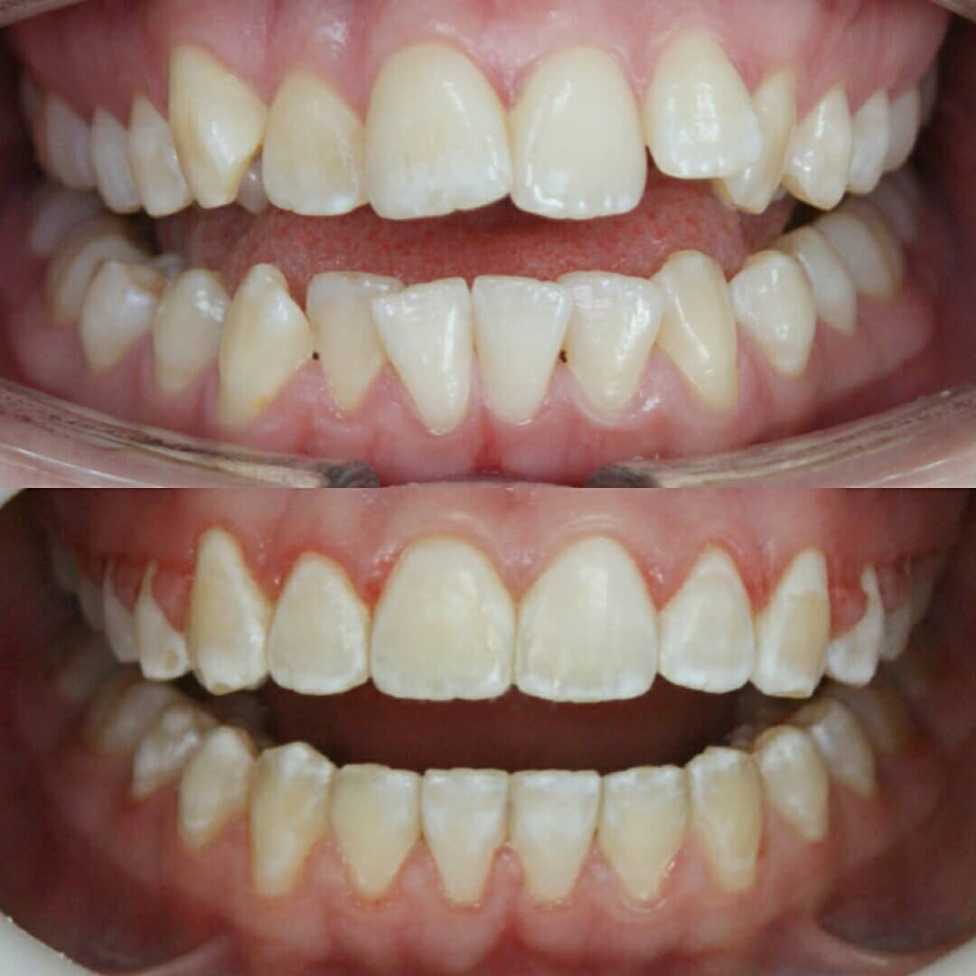 Блог врача. Стоматология «Ортодонт-Эстетик». Установка брекетов в Оренбурге, взрос