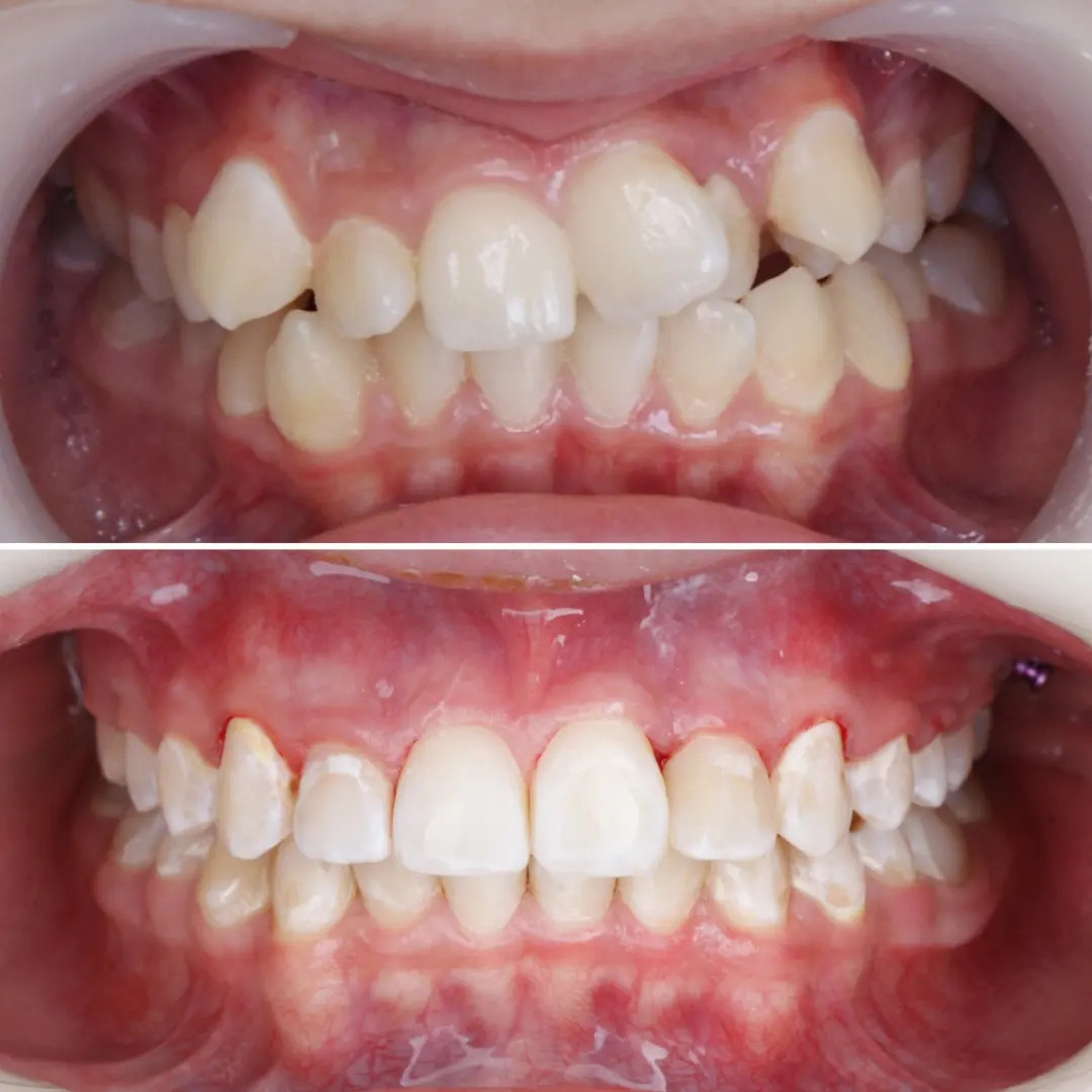 Блог врача. Стоматология «Ортодонт-Эстетик». Установка брекетов в Оренбурге, взрос