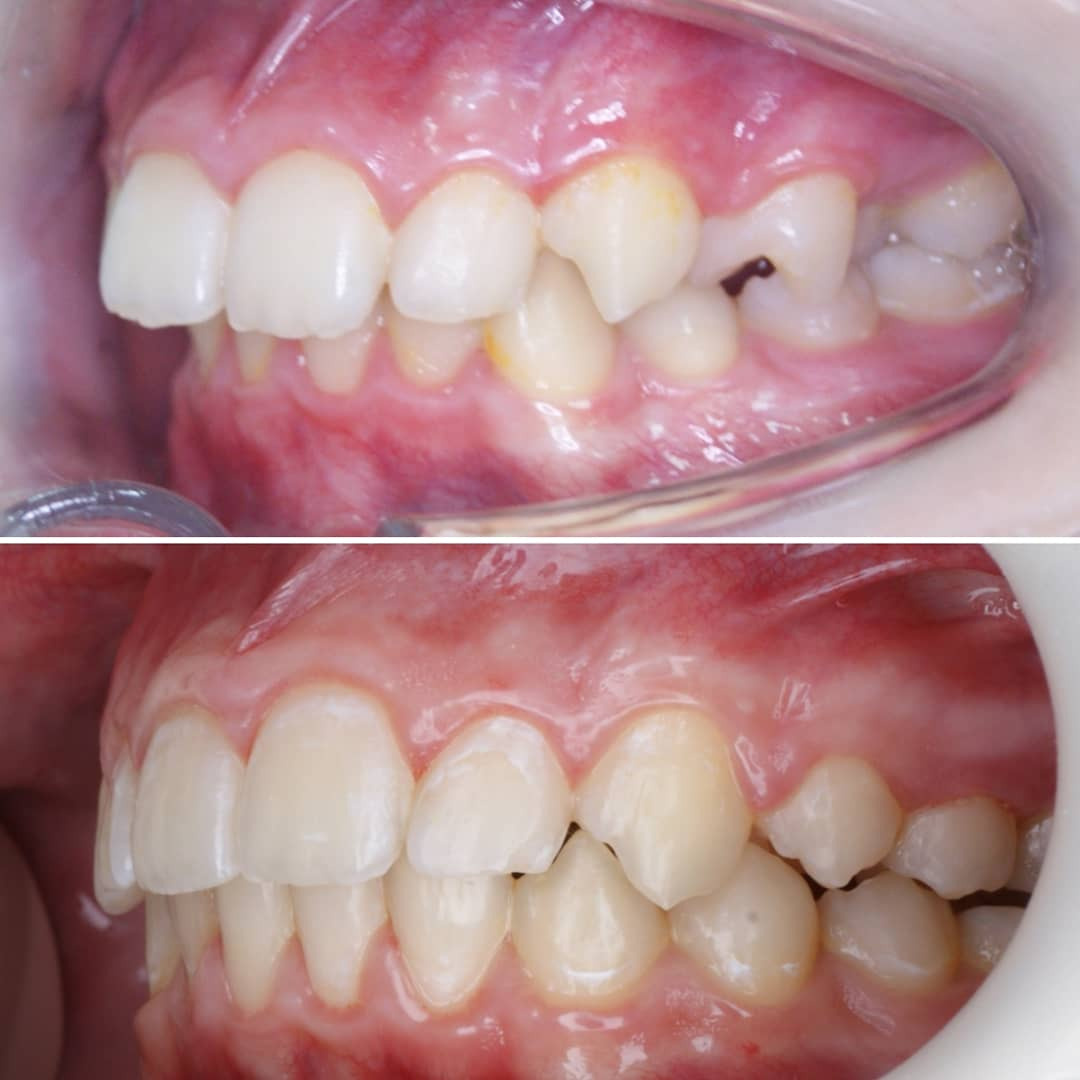 Блог врача. Стоматология «Ортодонт-Эстетик». Установка брекетов в Оренбурге, взрос