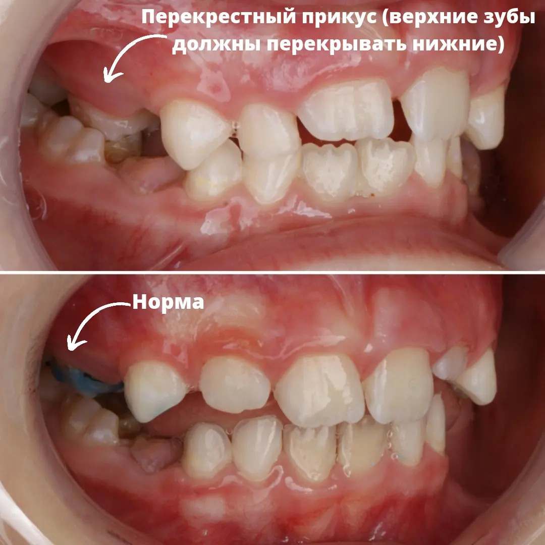 Блог врача. Стоматология «Ортодонт-Эстетик». Установка брекетов в Оренбурге, взрос