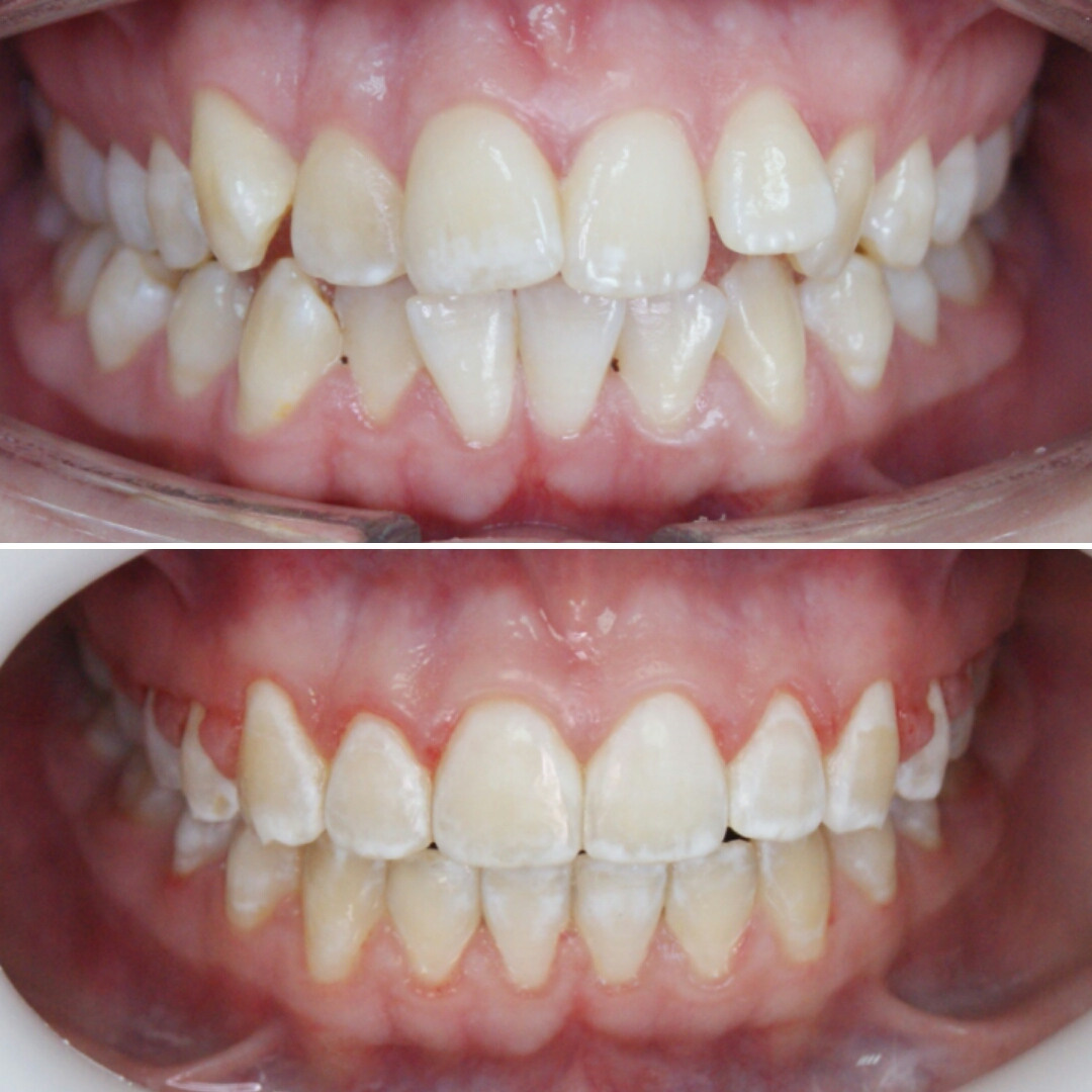 Блог врача. Стоматология «Ортодонт-Эстетик». Установка брекетов в Оренбурге, взрос