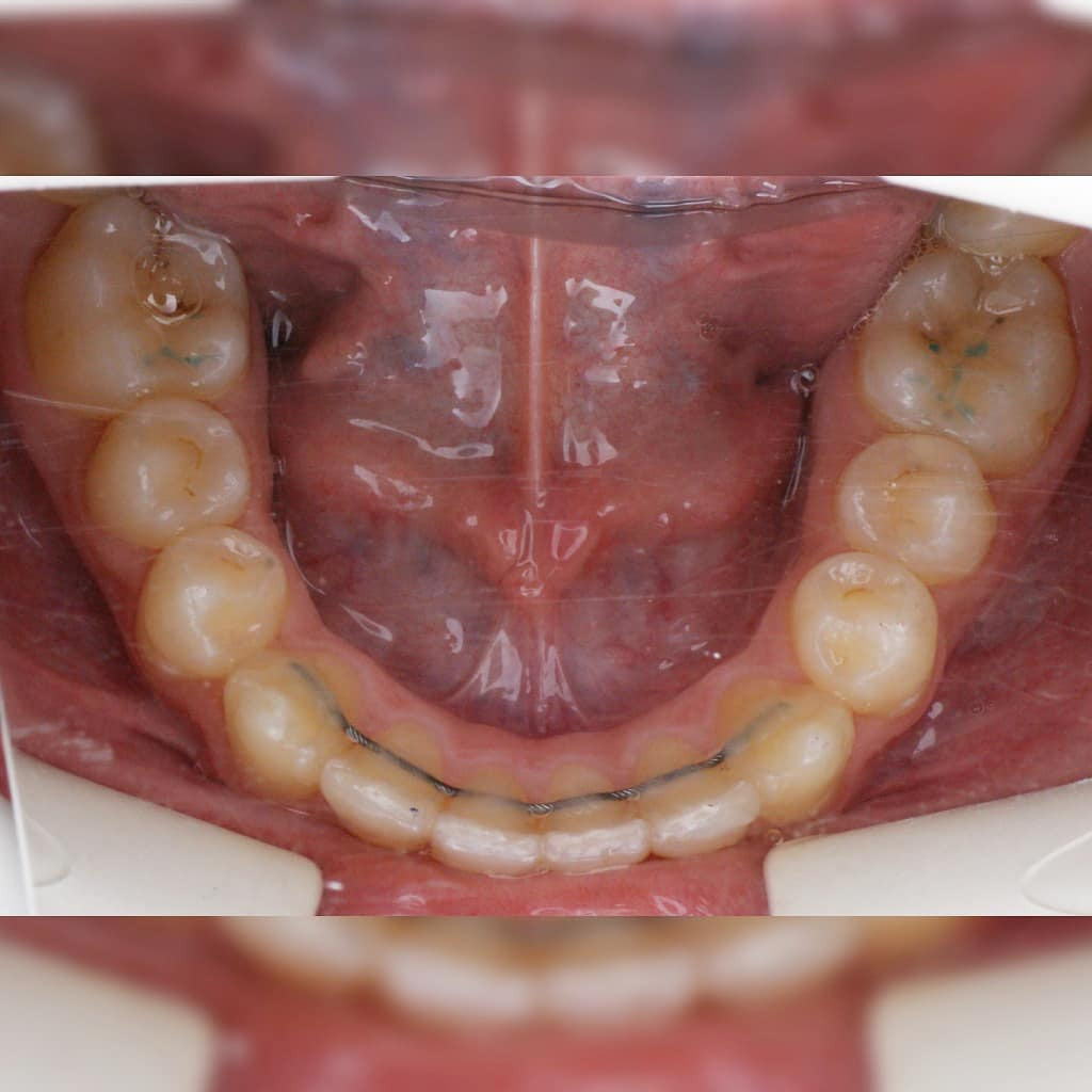 Блог врача. Стоматология «Ортодонт-Эстетик». Установка брекетов в Оренбурге, взрос