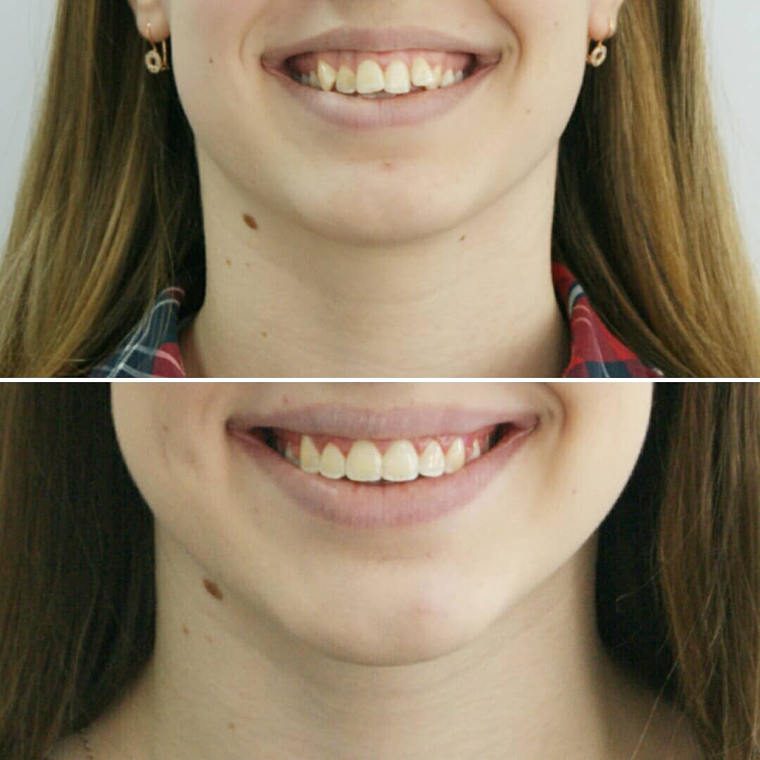 Блог врача. Стоматология «Ортодонт-Эстетик». Установка брекетов в Оренбурге, взрос