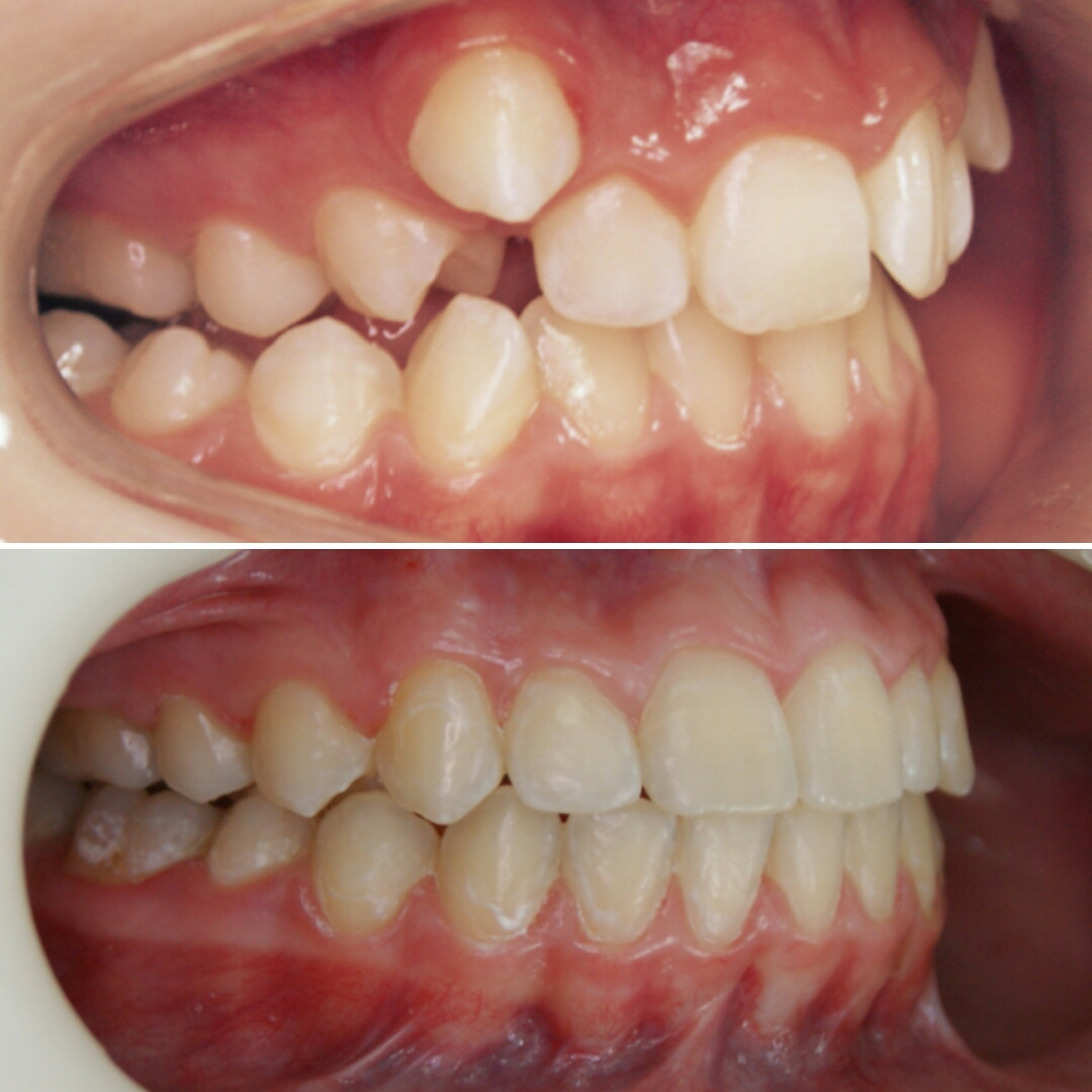 Блог врача. Стоматология «Ортодонт-Эстетик». Установка брекетов в Оренбурге, взрос