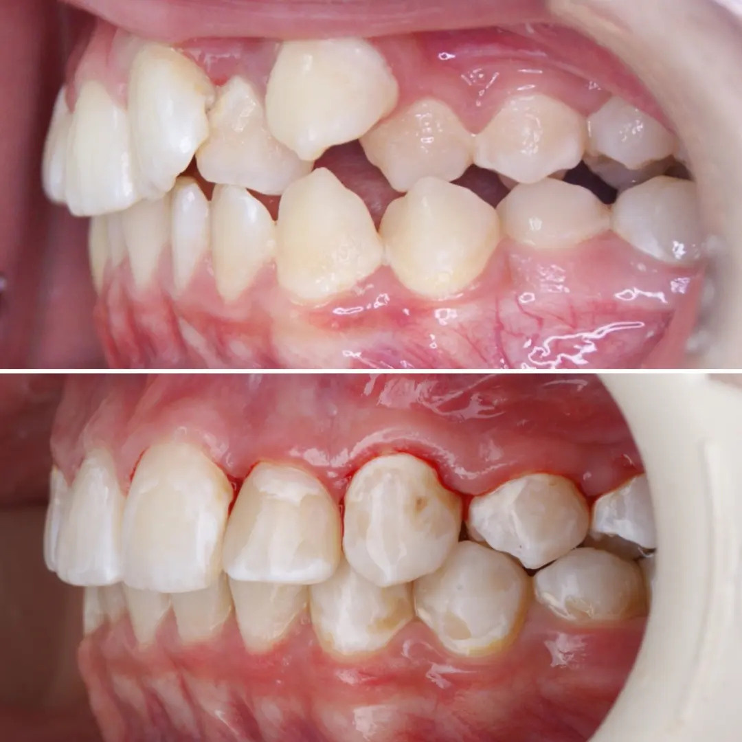 Блог врача. Стоматология «Ортодонт-Эстетик». Установка брекетов в Оренбурге, взрос