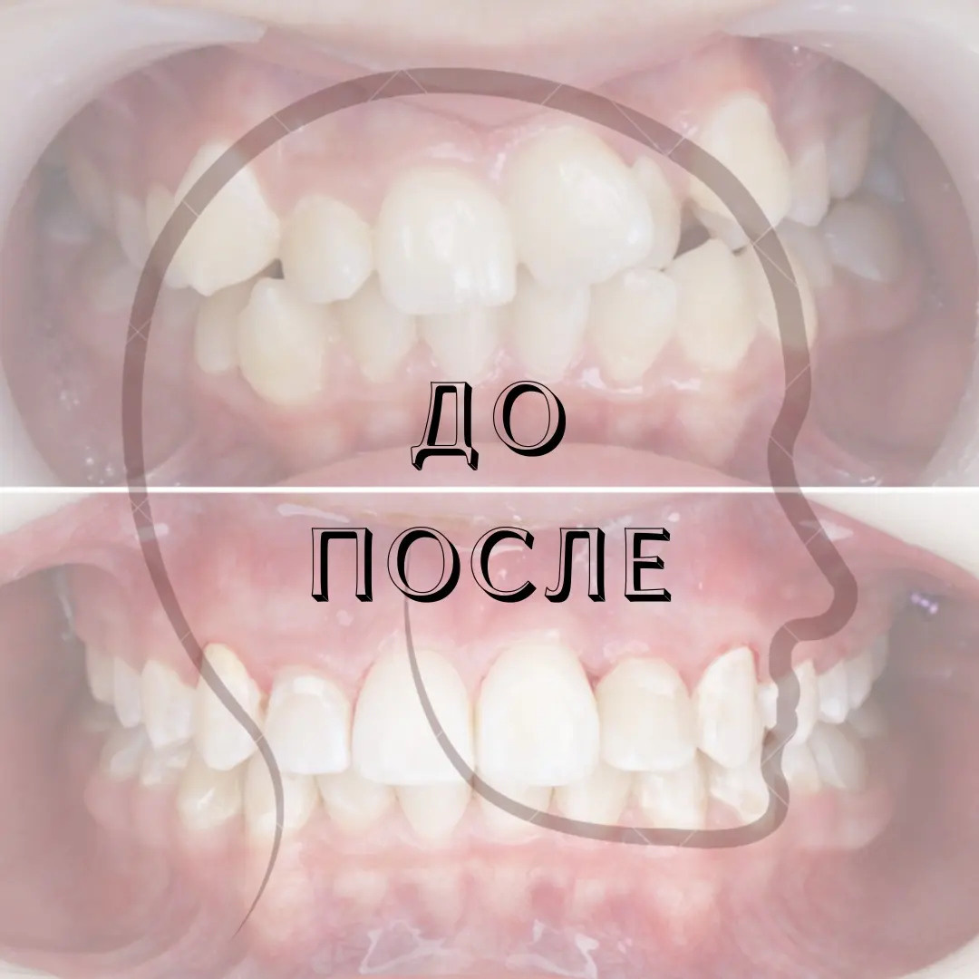 Блог врача. Стоматология «Ортодонт-Эстетик». Установка брекетов в Оренбурге, взрос