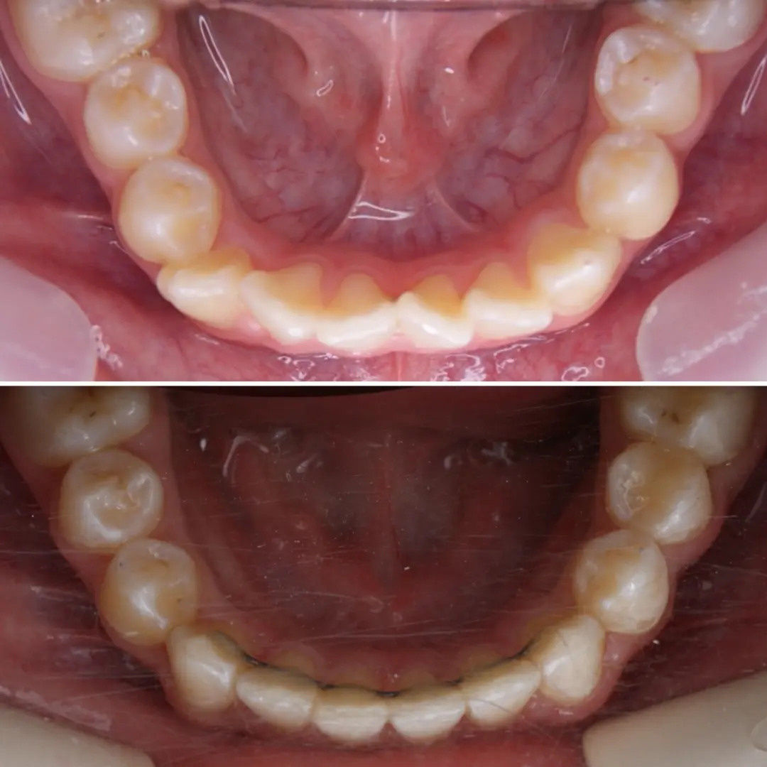 Блог врача. Стоматология «Ортодонт-Эстетик». Установка брекетов в Оренбурге, взрос