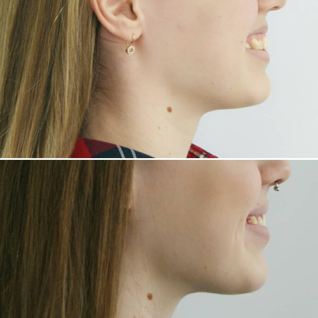 Блог врача. Стоматология «Ортодонт-Эстетик». Установка брекетов в Оренбурге, взрос