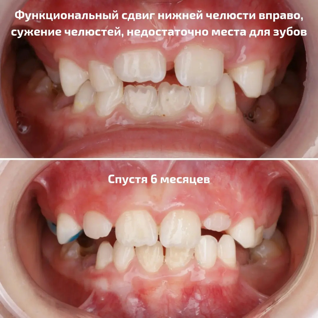 Блог врача. Стоматология «Ортодонт-Эстетик». Установка брекетов в Оренбурге, взрос