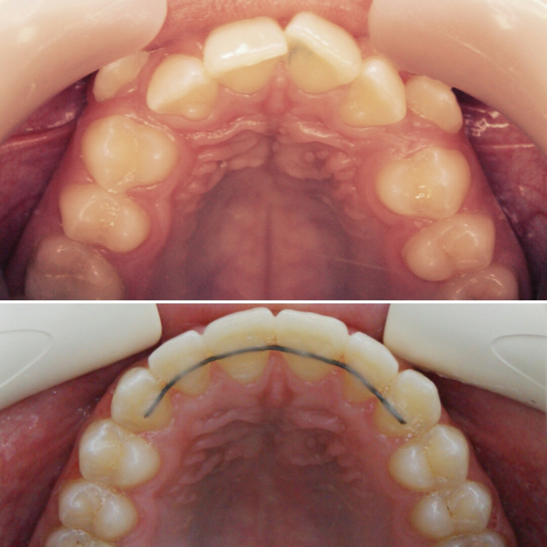Блог врача. Стоматология «Ортодонт-Эстетик». Установка брекетов в Оренбурге, взрос