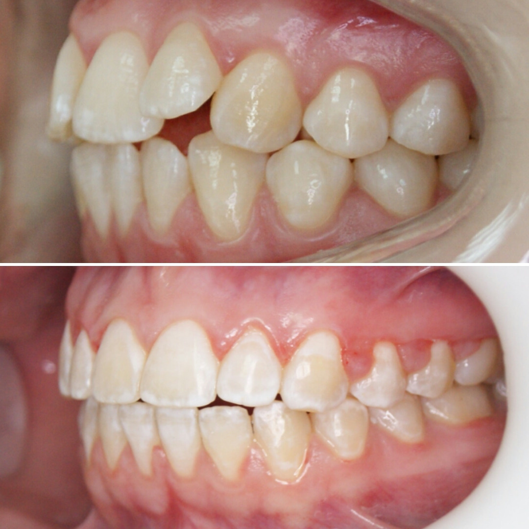 Блог врача. Стоматология «Ортодонт-Эстетик». Установка брекетов в Оренбурге, взрос