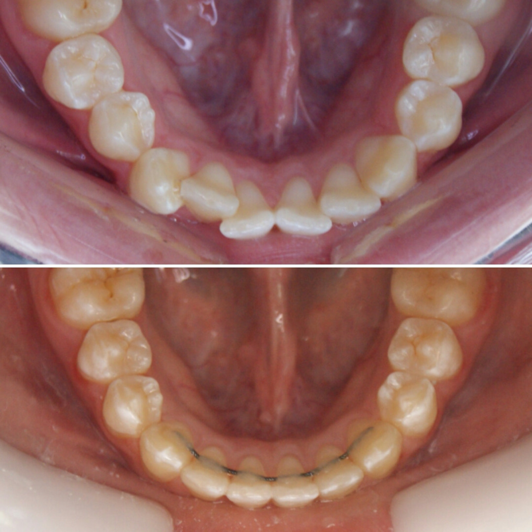 Блог врача. Стоматология «Ортодонт-Эстетик». Установка брекетов в Оренбурге, взрос