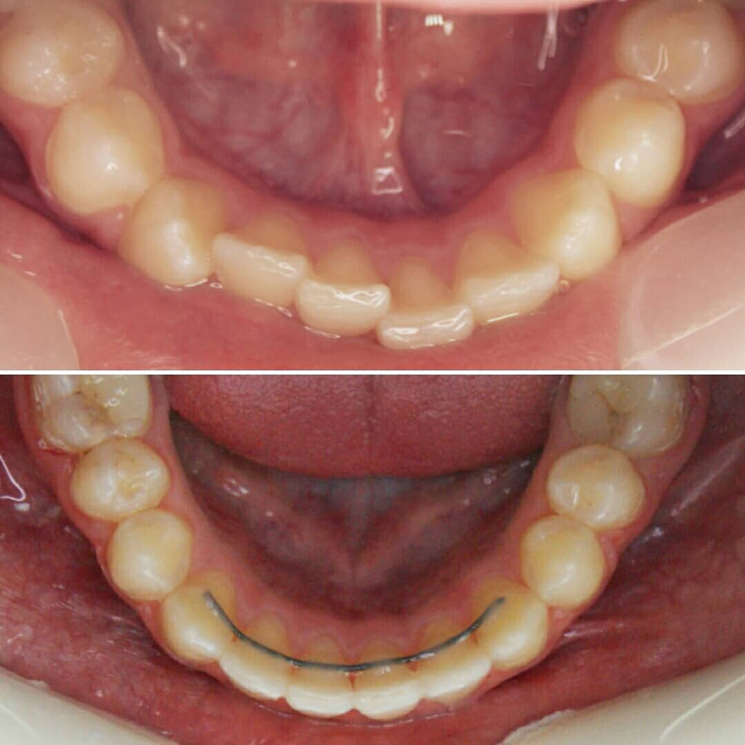 Блог врача. Стоматология «Ортодонт-Эстетик». Установка брекетов в Оренбурге, взрос