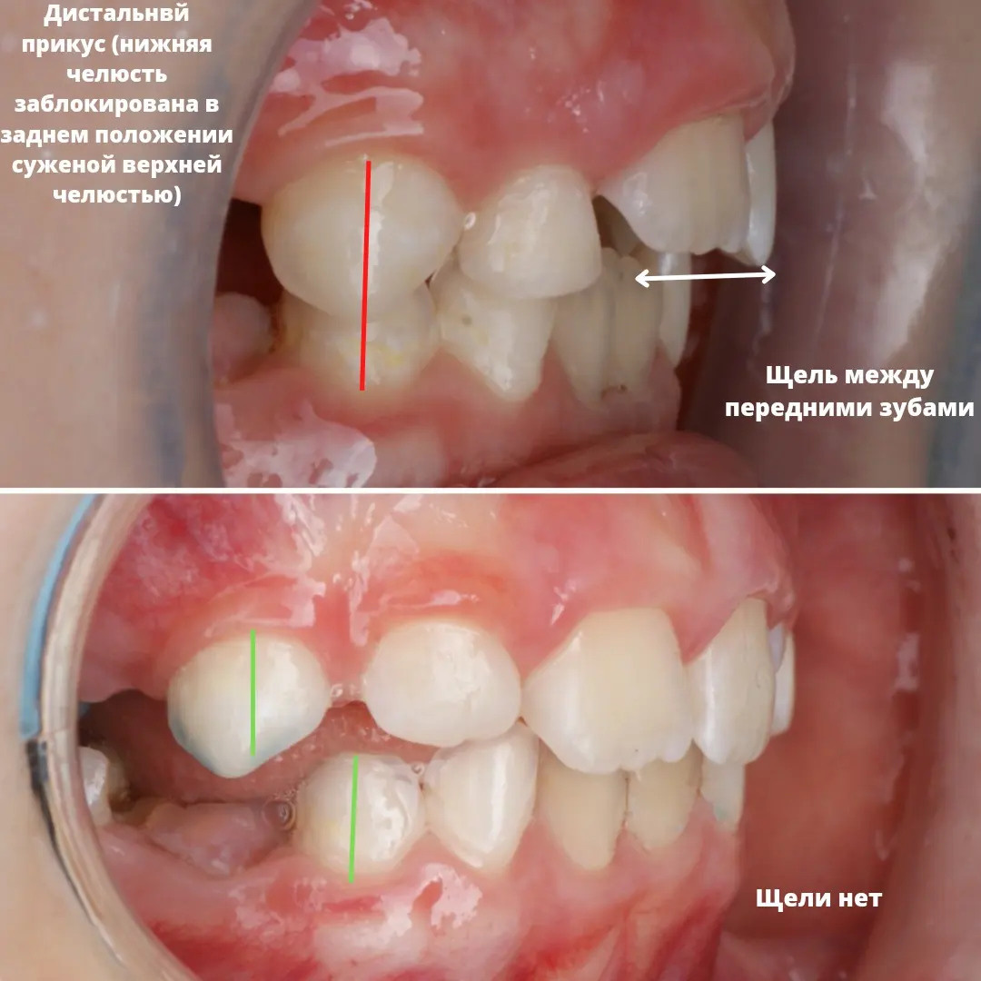 Блог врача. Стоматология «Ортодонт-Эстетик». Установка брекетов в Оренбурге, взрос